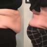 Body Contouring Fat Reduction, Skin Tightening, & Butt lift